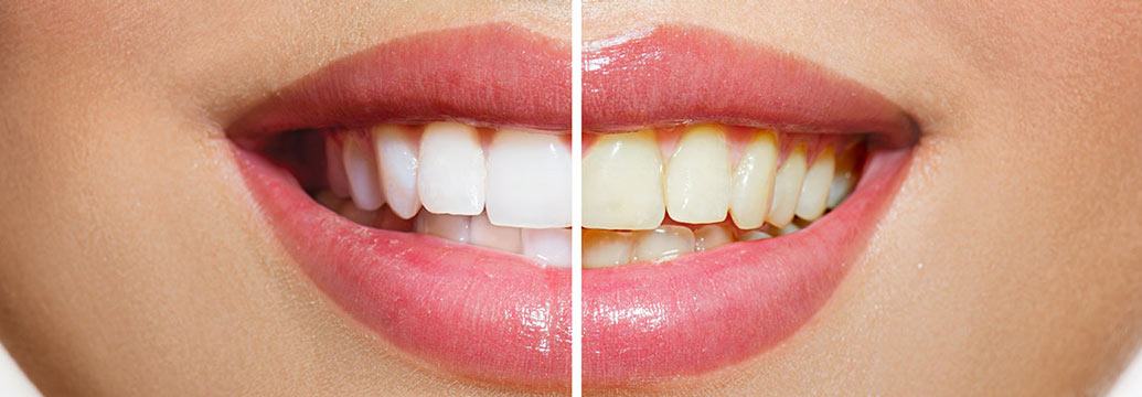 Before and After Image of a Teeth Whitening Treatment